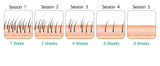 Digital IPL Laser Hair Removal