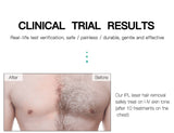 Digital IPL Laser Hair Removal